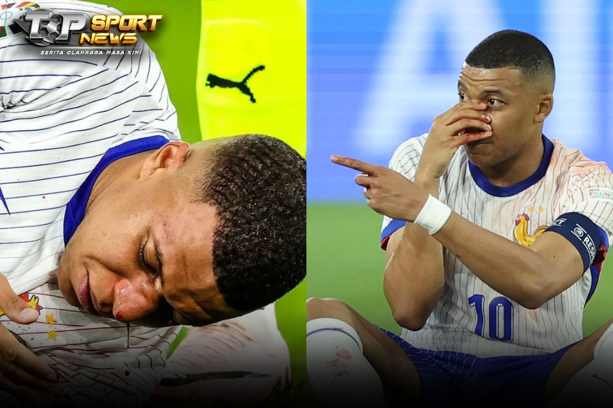 Cedera! Kylian Mbappe mengalami Tulang Hidung Patah, Main Pakai Topeng?